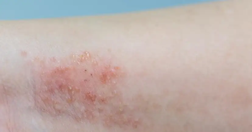 Alergia u dziecka: Jaki lek wybrać? Kiedy do lekarza?