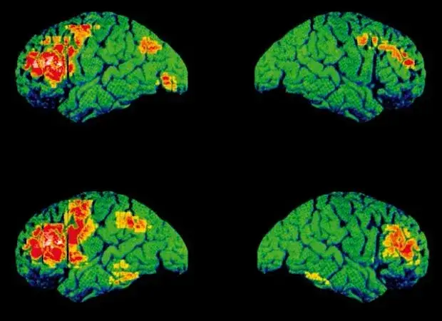 Depresja czy schizofrenia? Porównanie i fakty – Matylda Kowalczyk