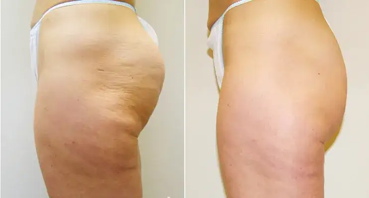 Skuteczne sposoby na cellulit, które naprawdę działają i przynoszą efekty