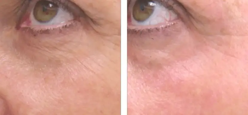 Laser frakcyjny: Ile zabiegów na blizny, zmarszczki i rozstępy?