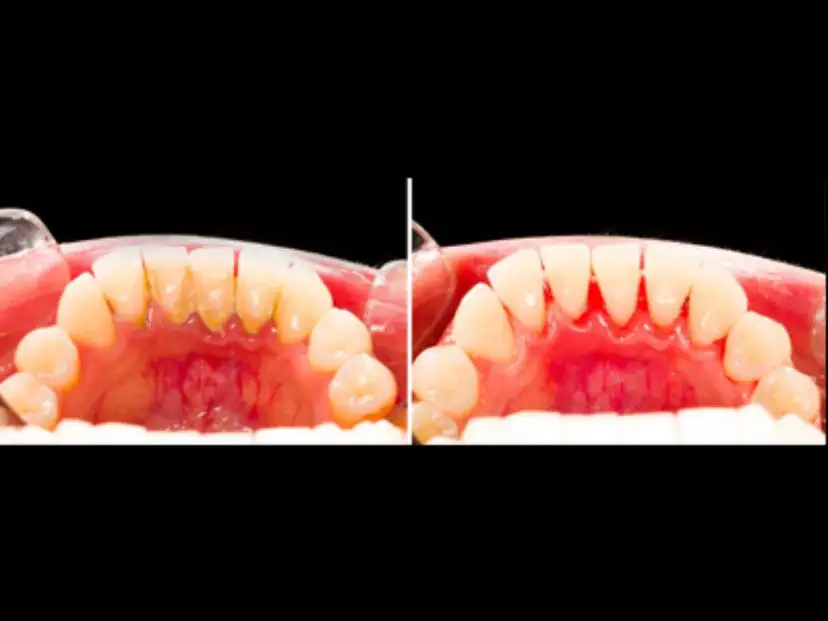 Przed i po zabiegu: zęby z kamieniem nazębnym i zdrowe, czyste zęby. Dowiedz się, jak usunąć kamień nazębny.