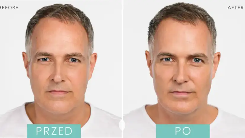 Ile to jest 1 ml kwasu hialuronowego i jak wpływa na efekty zabiegów?