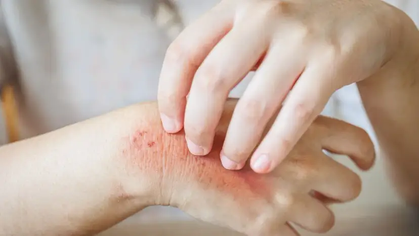 Co na liszaj u dziecka - poznaj skuteczne metody leczenia i objawy