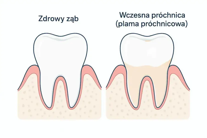 Zdrowy ząb obok zęba z wczesną próchnicą, czyli plamą próchnicową. Dentysta widzi różnicę w kolorze i strukturze szkliwa.