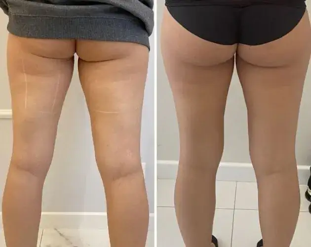 Redukcja cellulitu na udach: Twój plan na gładką skórę