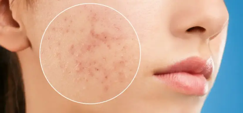 Co powoduje pryszcze? Poznaj przyczyny i sposoby na ich uniknięcie