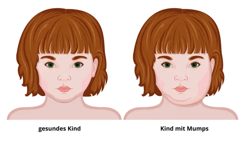 Mumps-Symptome: Erkennen, Verlauf & Komplikationen | Was tun?
