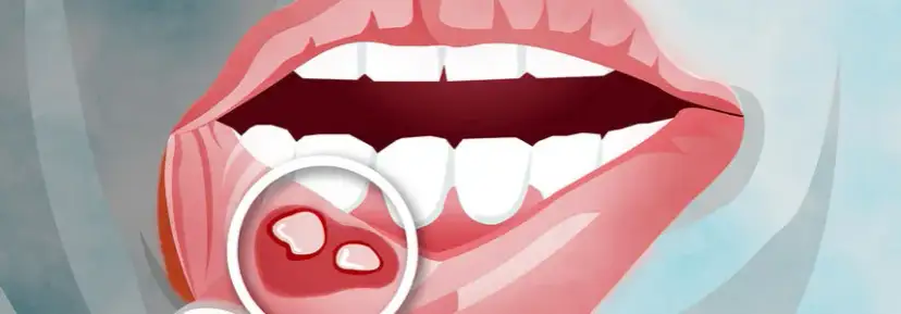 Choroba Leśniowskiego-Crohna: objawy w jamie ustnej, które musisz znać