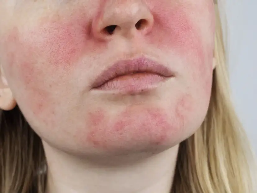 Schuppige & gerötete Haut: Ist es Rosacea? Ursachen & Lösungen