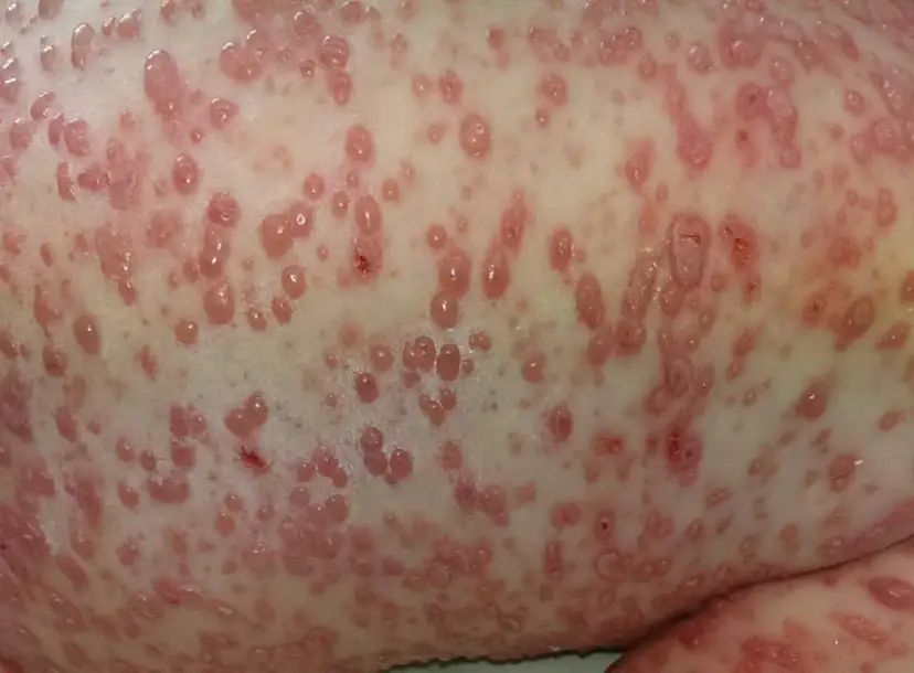 Ospa: Strupy nie zarażają? Kiedy dziecko może wrócić do przedszkola?