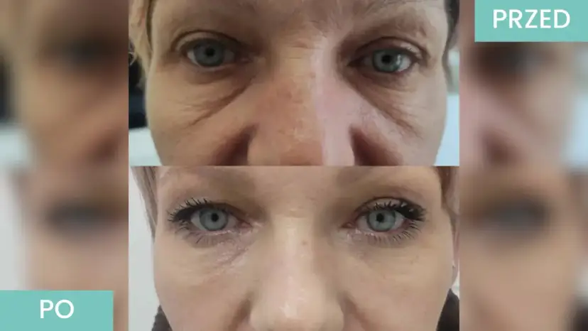 Botoks czy kwas hialuronowy na kurze łapki? Który wybrać?