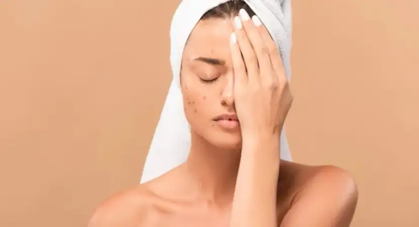 Czy wolno wyciskać pryszcze? Oto skutki, które musisz znać