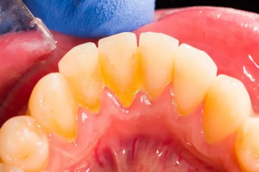 Żółtawa warstwa na zębach to płytka nazębna, która gromadzi się przy dziąsłach.