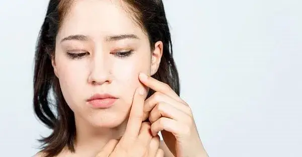 Czy wyciskanie pryszczy jest zdrowe? Odkryj ryzyko i skutki tej praktyki