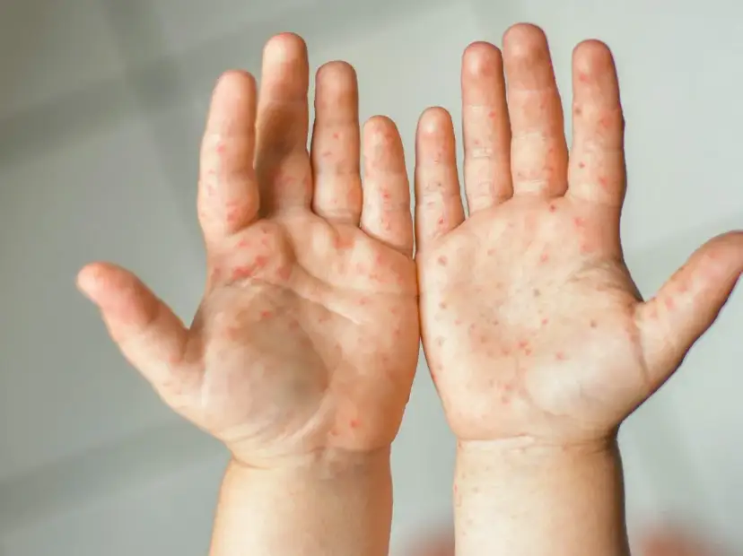 Dłonie dziecka pokryte czerwonymi kropkami, objaw bostonki.