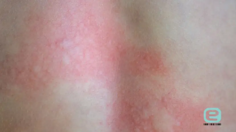 Ugryzienie kleszcza: objawy, rumień, KZM kiedy do lekarza?