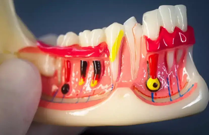 Zgorzel zęba: Jak długo boli i co przyniesie natychmiastową ulgę?