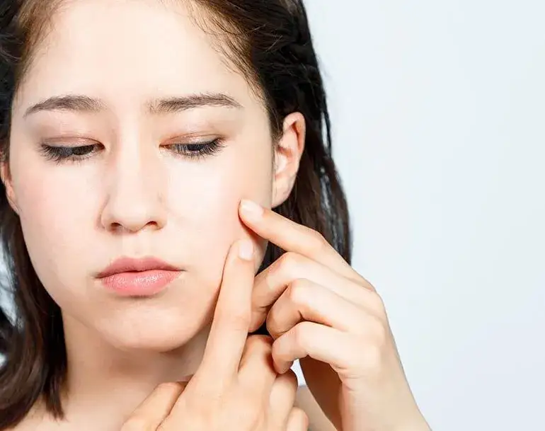 Czy pryszcze same znikają? Sprawdź, kiedy potrzebna jest pomoc dermatologa