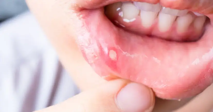 Widoczne białe owrzodzenie na czerwonym, opuchniętym policzku. To duża afta, która sprawia ból.