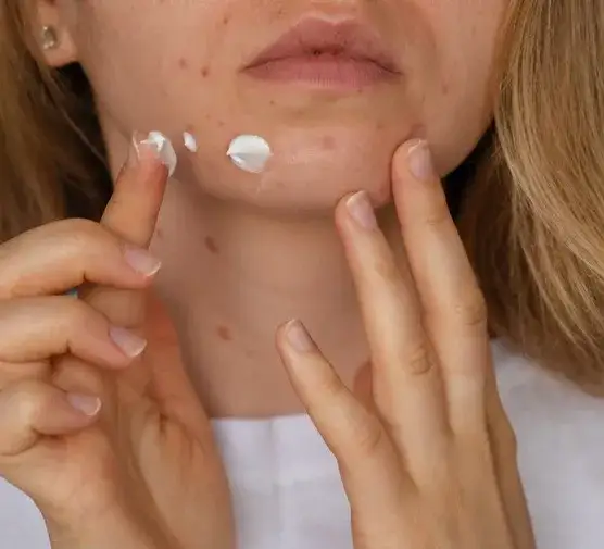 Czy pasta do zębów wysusza pryszcze? Prawda o skuteczności i ryzyku