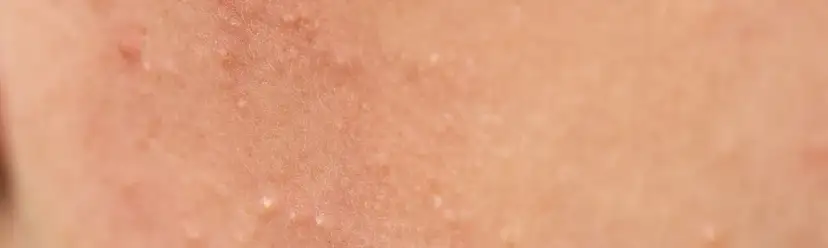 Jak wygląda zapchana cera i jak ją skutecznie wyleczyć?