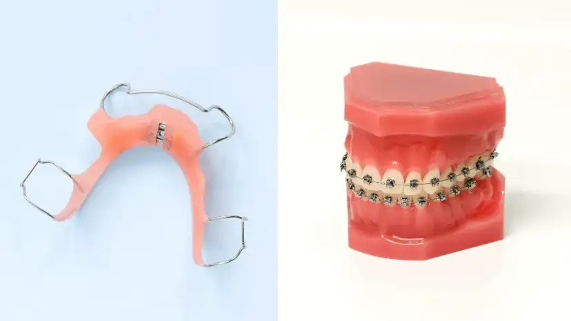 Nakładki czy aparat stały? Porównanie, koszty i wybór dla Ciebie