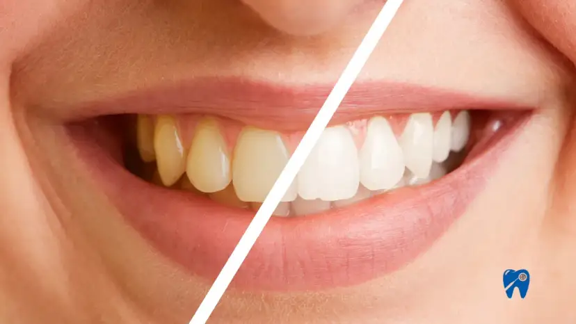 Piwo a przebarwienia zębów: Jak pić i zachować biały uśmiech?