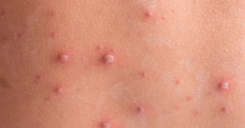 Skóra dziecka z licznymi pęcherzykami i krostkami, charakterystycznymi dla ospy. Wskazówki, jak kąpać dziecko z ospą, pomogą złagodzić swędzenie.