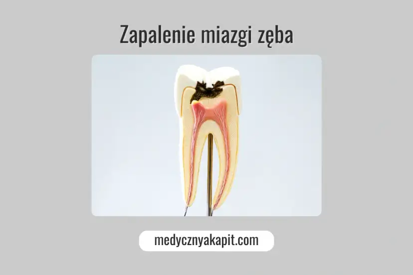 Przekrój zęba z widocznym zapaleniem miazgi. Widoczna próchnica sięgająca do miazgi jedynki.