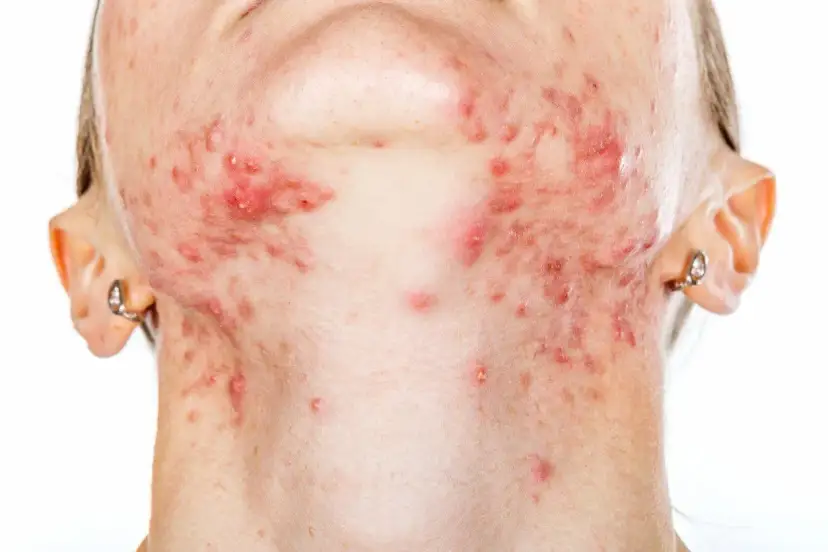 Pryszcze na szyi: Co Ci mówią? Przyczyny, mapa i jak z nimi walczyć