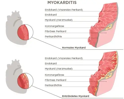 Myokarditis Symptome: Warnsignale, die Sie nicht ignorieren sollten