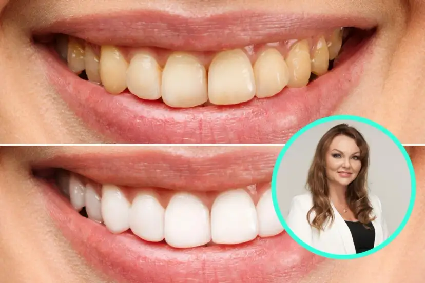 Żółte zęby? Poznaj przyczyny i odzyskaj biały uśmiech!