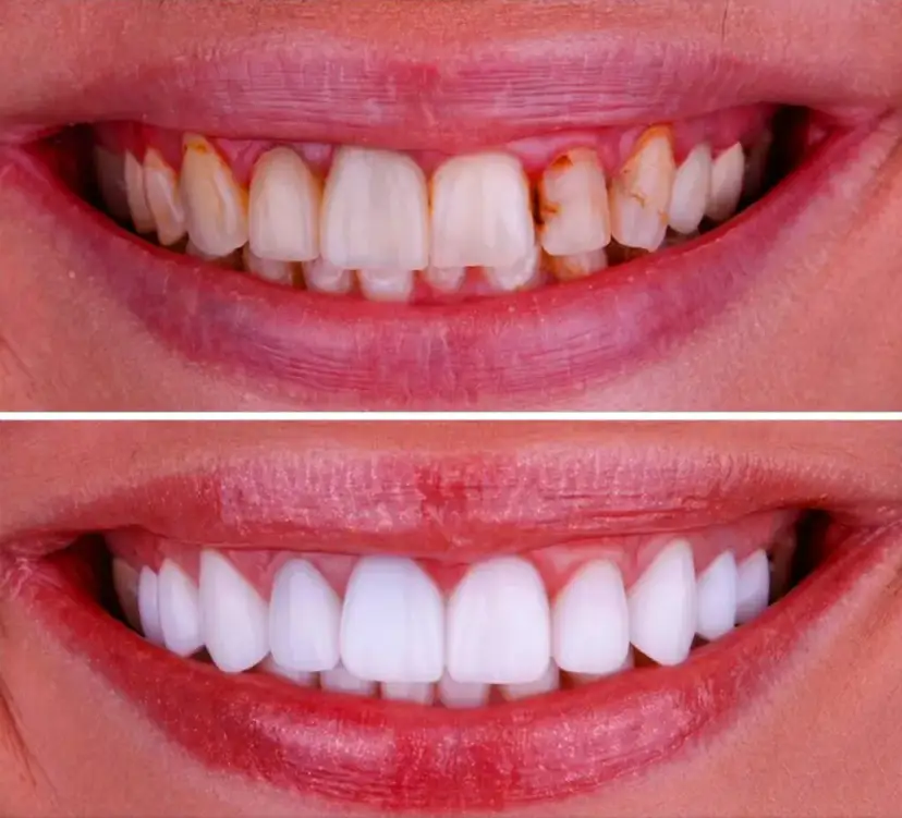 Czym wypełnić ubytek w zębie? Poznaj najlepsze materiały i ich zalety