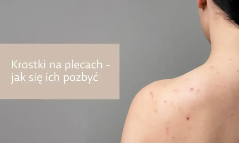Krostki na plecach jak się pozbyć? Widok pleców z widocznymi zmianami trądzikowymi.