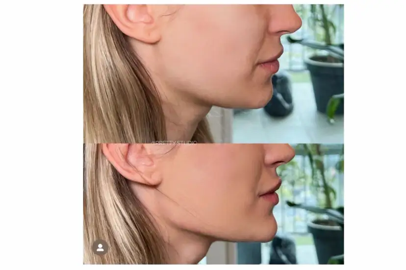 Endermologia twarzy: Lifting bez skalpela? Sprawdź efekty!