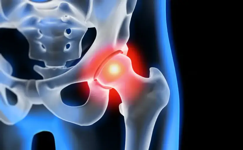 Coxarthrose Symptome: So erkennen Sie die schmerzhaften Anzeichen