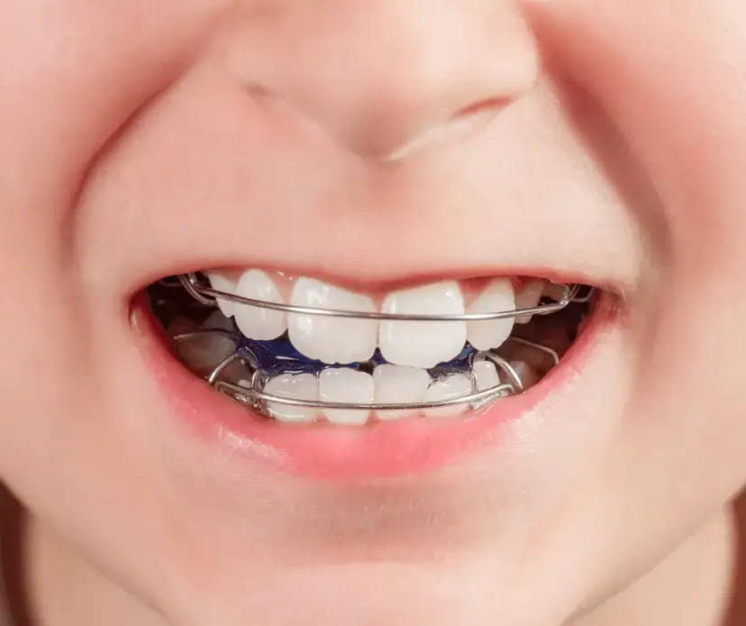 Jak wygląda ruchomy aparat na zęby dla dzieci? Wszystko, co musisz wiedzieć