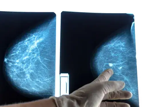 Guzek na piersiach: do jakiego lekarza się udać i kiedy to pilne?