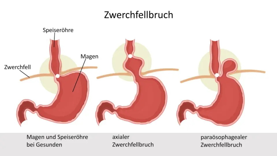 Zwerchfellbruch erkennen - typische Symptome und Warnzeichen