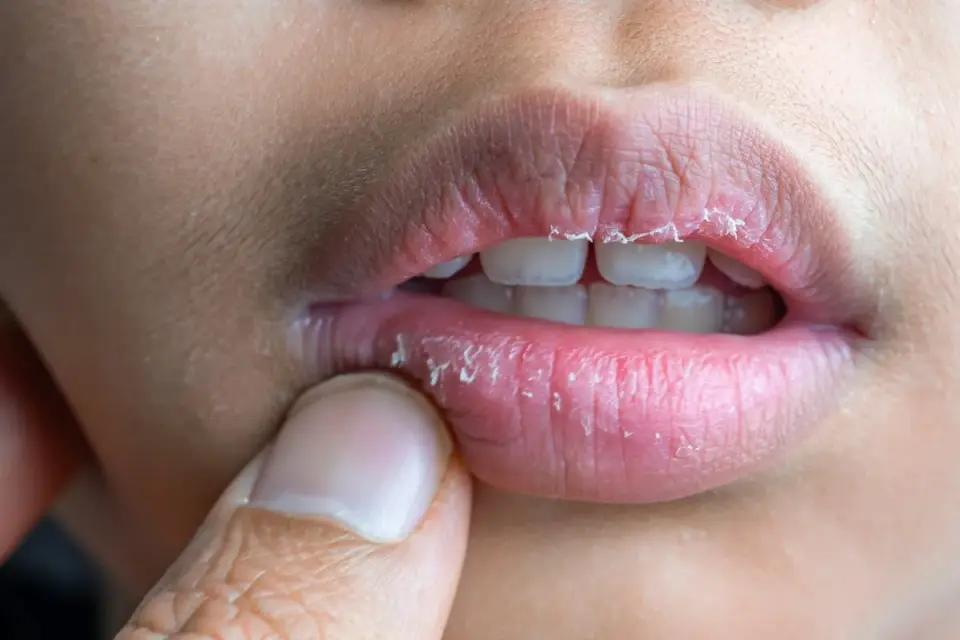 Labios resecos aunque bebas agua - qué los causa y cómo cuidarlos