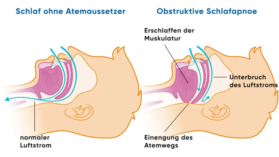 Schlafapnoe und Herzrasen - warum Atemaussetzer den Puls treiben