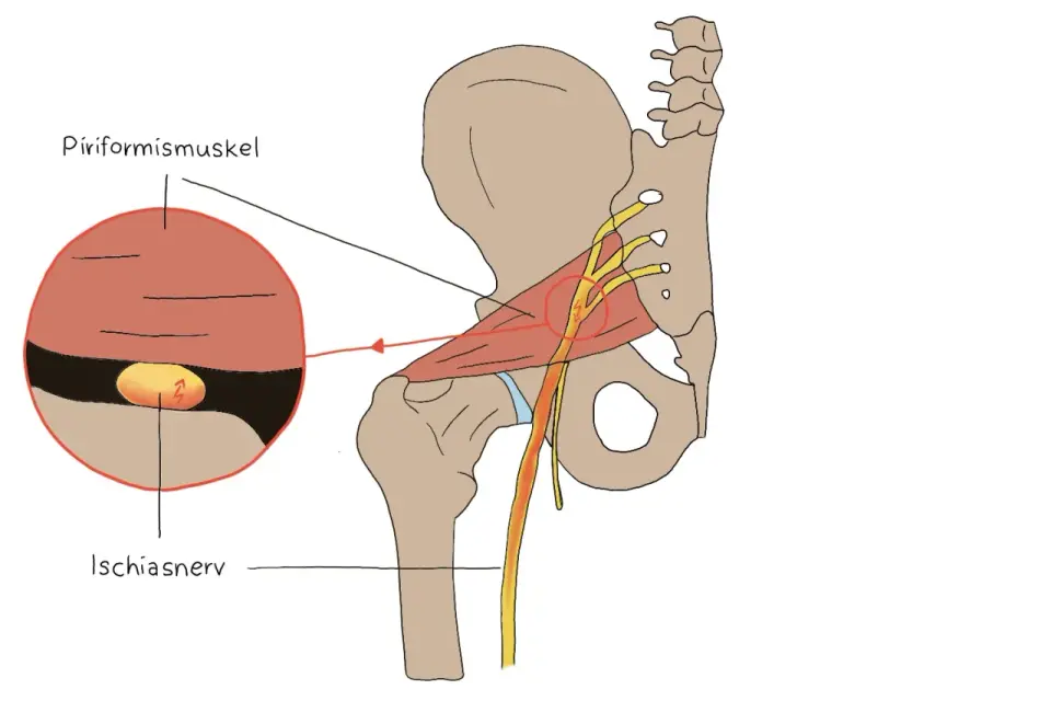 Piriformis-Syndrom erkennen und was wirklich hilft