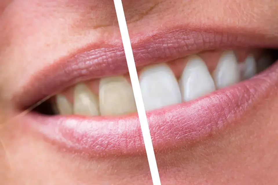 Placca dentale - come riconoscerla e rimuoverla davvero