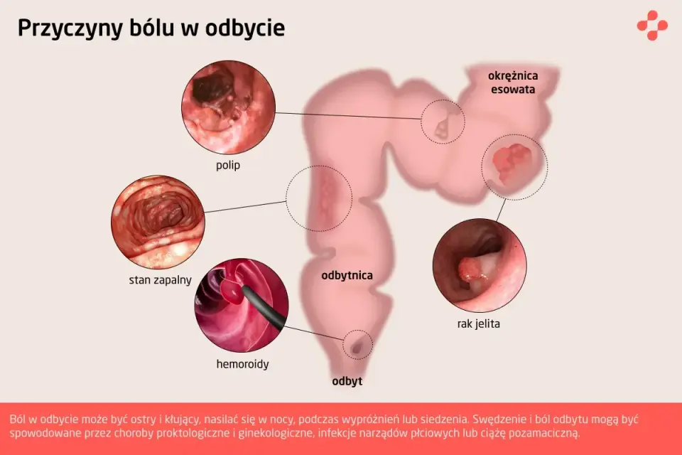 Ból odbytu - Przyczyny, objawy, leczenie. Kiedy do lekarza?