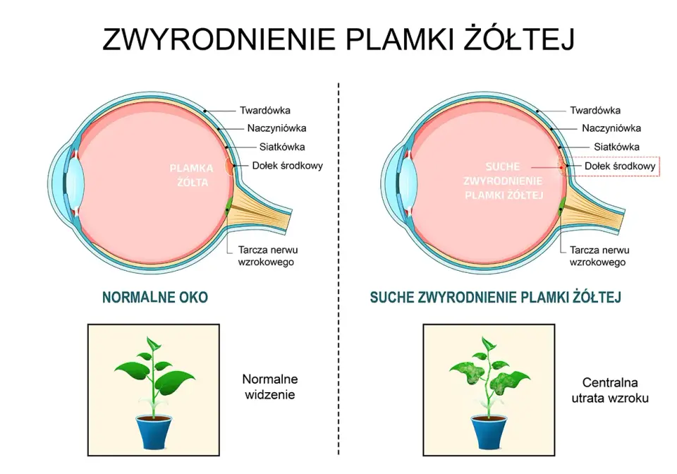 Zwyrodnienie plamki żółtej (AMD) - Objawy, leczenie, profilaktyka