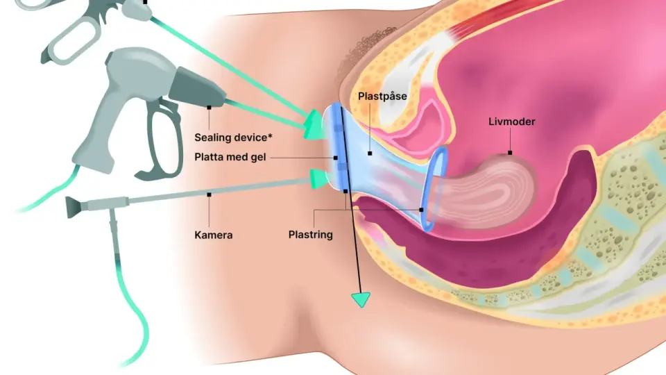 Vaginal åtstramning - vad som faktiskt fungerar