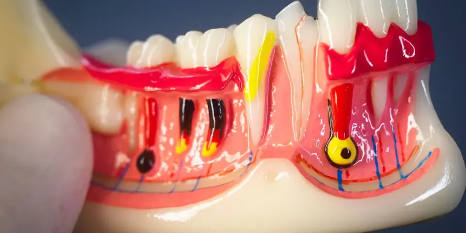 Colletto dentale sensibile? Cause, segnali e rimedi utili
