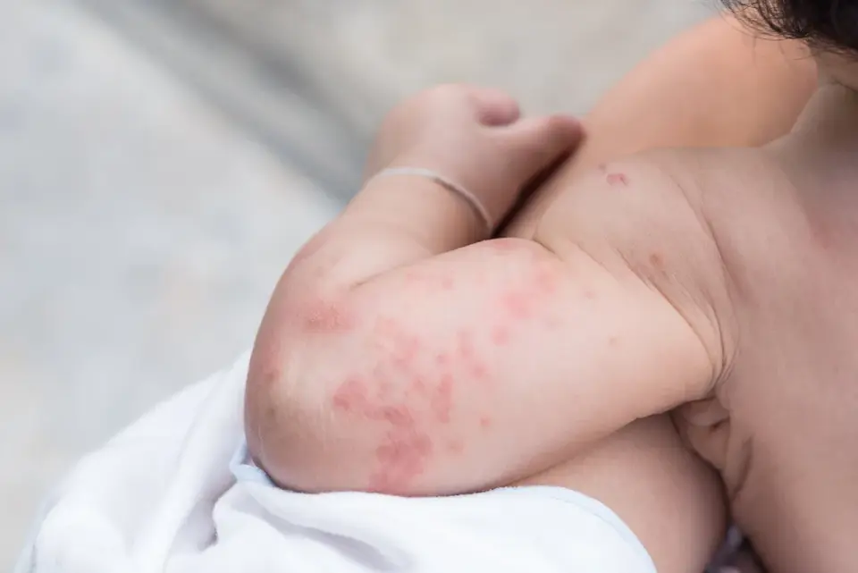 Urticaria en niños - cómo reconocerla y cuándo preocuparse