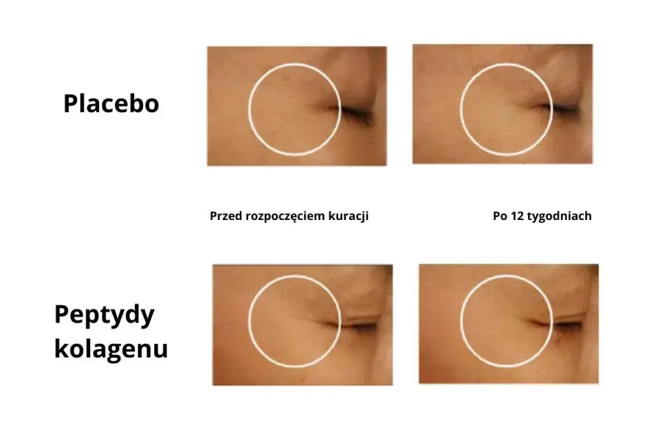 Kolagen po suplementacji - kiedy szkodzi, a kiedy to choroba?