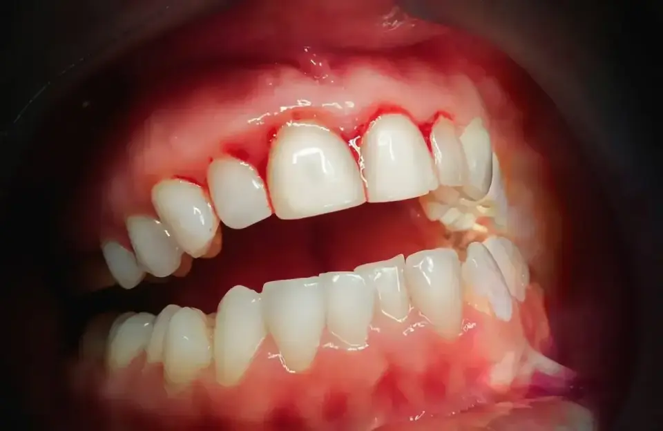 Martwica dziąsła - jak rozpoznać i kiedy iść do dentysty?
